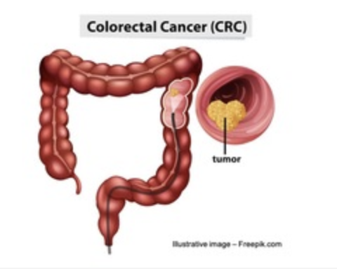 Method for Identification of Relapse Risk and Treatment in Patients with Colorectal Cancer