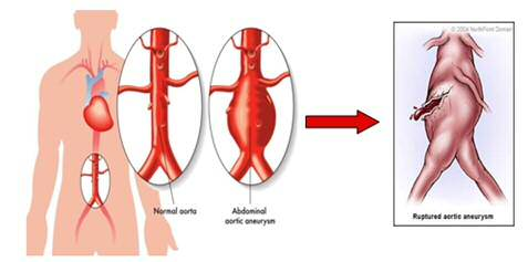 Peptide for the prevention and treatment of aneurysm