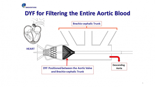 Novel Emboli Capturing and Removal Double-Filtering System for Whole-Body Prevention of Embolic Complications During and After TAVI / TAVR Procedures